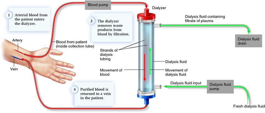 Hemodialysis Process Dr Satish Nephrologist And Transplant Physician 3874